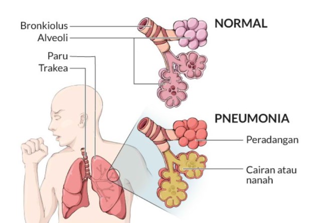 Pneumonia Mengenal Gejala Penyebab Dan Pencegahannya